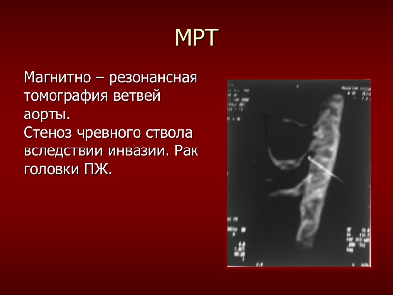 МРТ Магнитно – резонансная  томография ветвей  аорты.  Стеноз чревного ствола 
